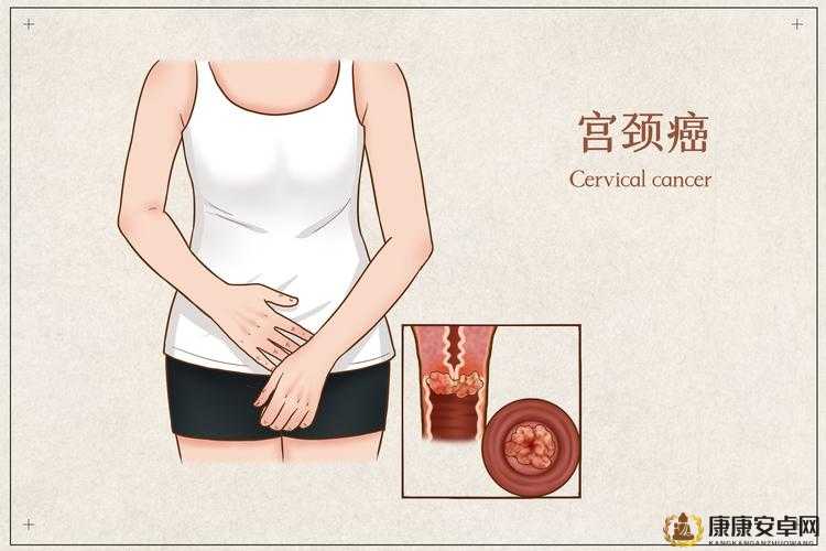 高危型 HPV16-27-8 阳性持续感染与宫颈癌前病变及宫颈癌的相关性研究